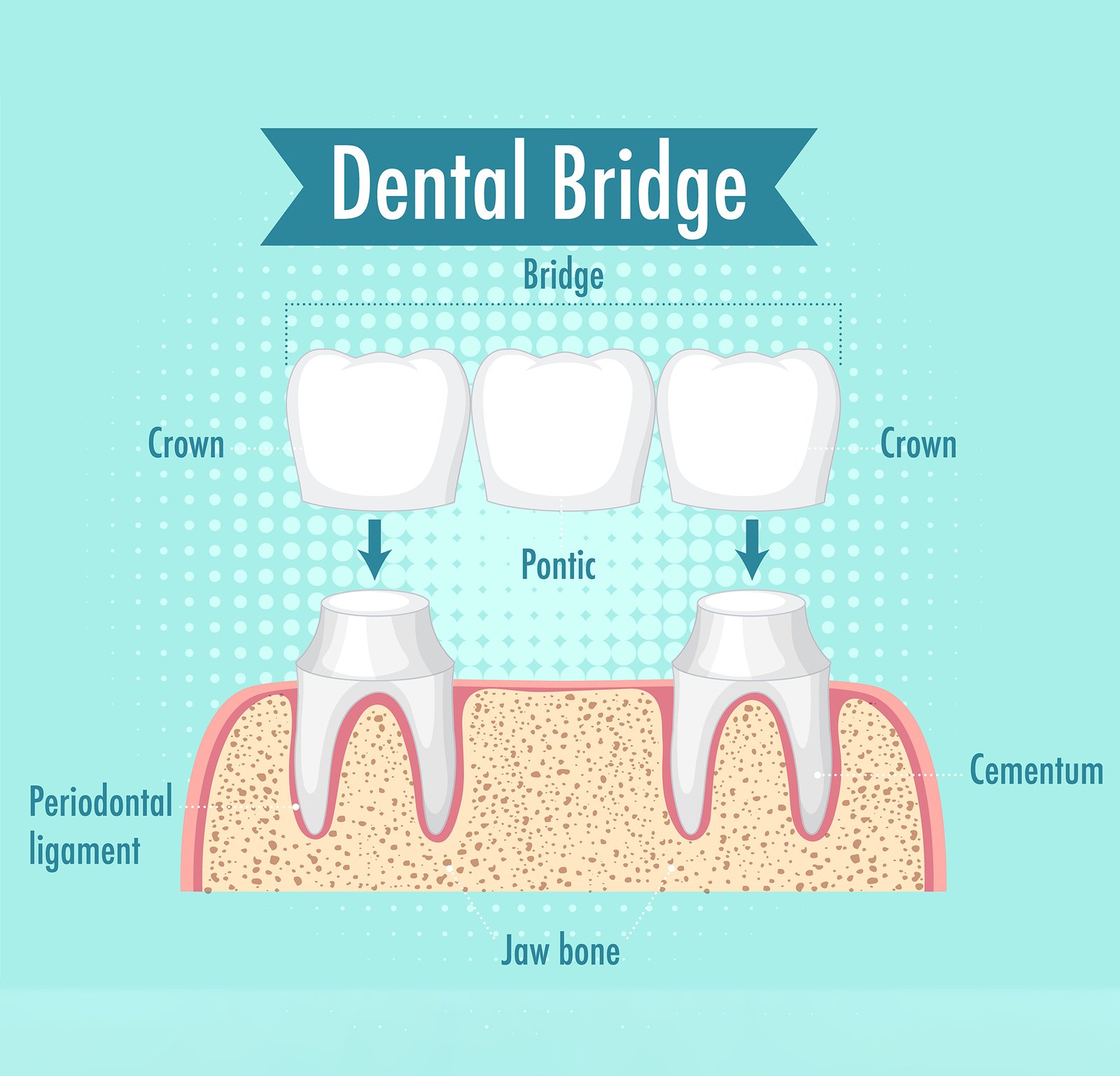 dental-bridges.jpg