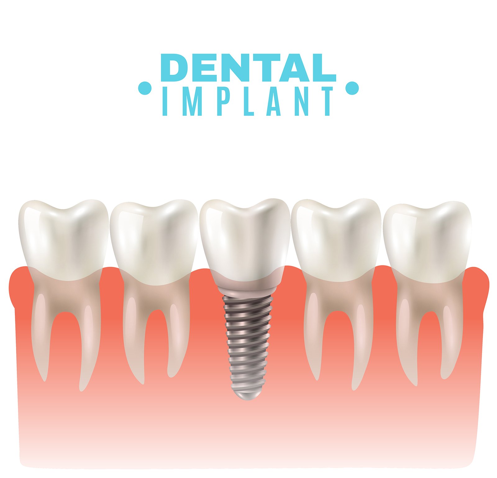 dental-implant.jpg